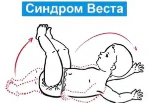 Синдром Веста